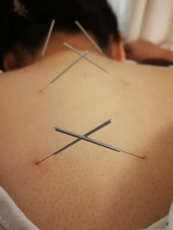 背中に刺したのは肺兪、心兪、大杼。肩こり対策のツボは大杼のみ。本当の鍼治療は鍼の本数が少ないです。