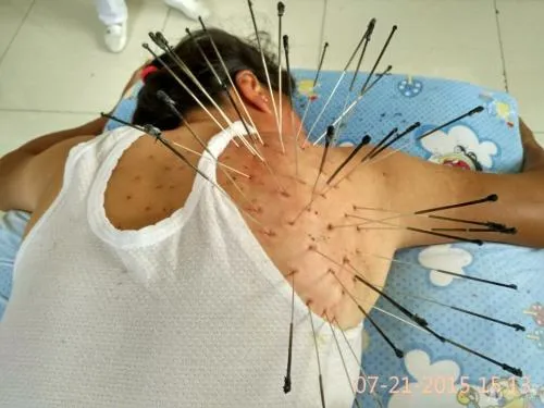 うつ伏せの男性の肩と肩甲骨に、太くて長い鍼が数十本刺さった状態の鍼灸施術画像