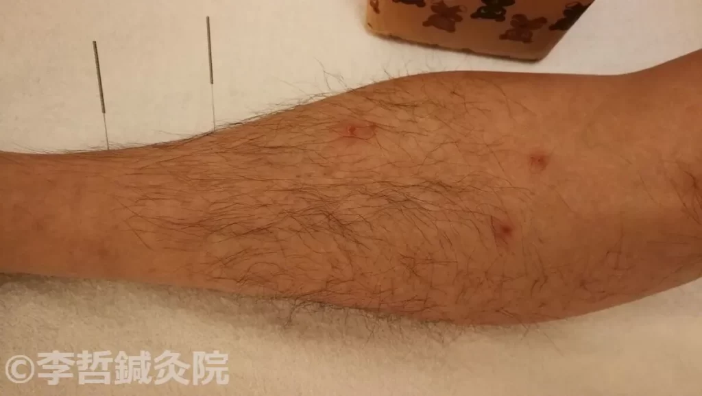 亜鉛サプリ飲用後にできた左足の赤い発疹。三陰交と築賓に鍼を刺した治療中の様子で、直径約0.5cmの凹んだ発疹が数箇所見られます。