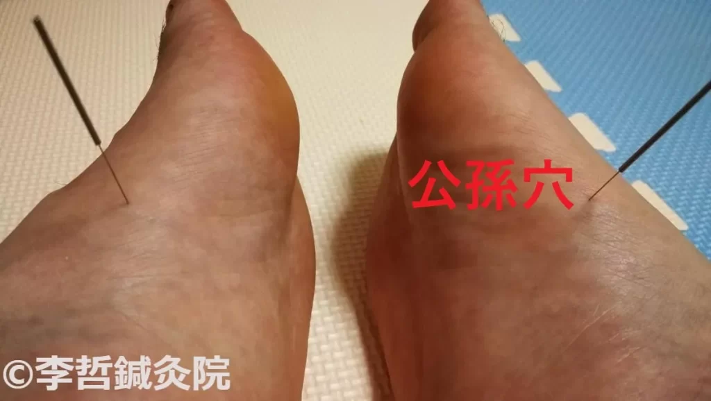 足の公孫穴に鍼を刺して食あたりによる吐き気と胃のムカムカを治療している様子