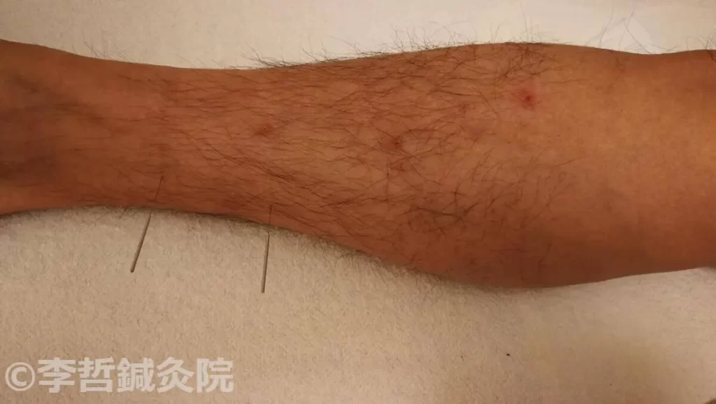亜鉛サプリ飲用後にできた右足の赤い発疹。三陰交と築賓に鍼を刺した治療中の様子で、直径約0.5cmの凹んだ発疹が数箇所見られます。