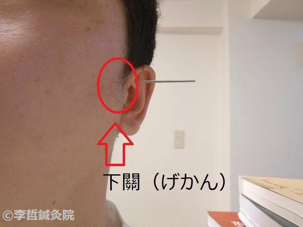 顔に下關（げかん）のツボへ鍼を刺した実例写真。赤丸で位置表示