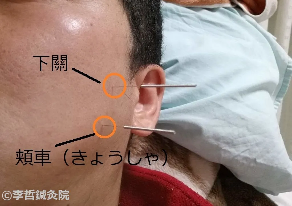 顔面鍼治療のツボ位置を示した写真。頬車（きょうしゃ）と下關（げかん）にオレンジ丸とラベル付き