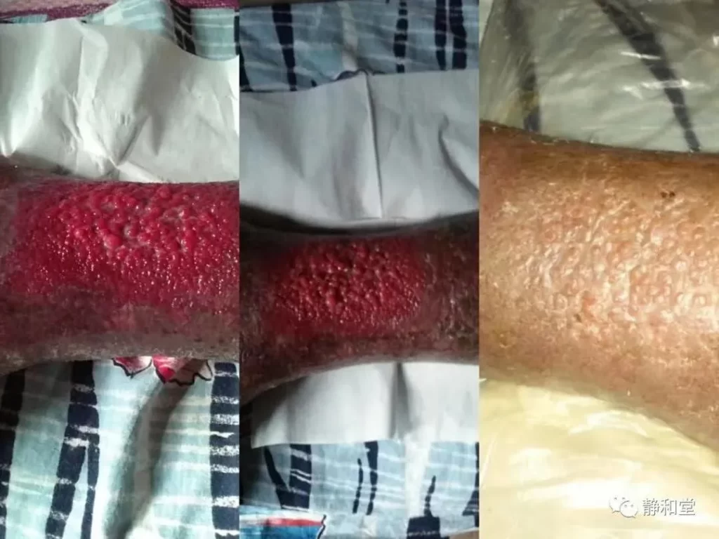 94歳女性の前脛部潰瘍・治療前（赤黒く腐敗＋黄色滲出液）