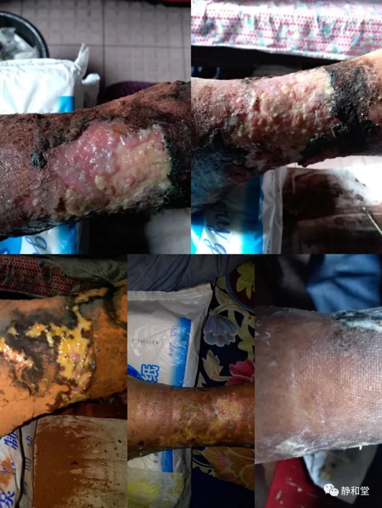 94歳女性の前脛部潰瘍・治療前（筋肉露出レベルの腐敗・5枚組）  