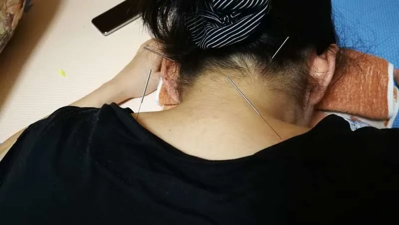 鍼治療で偏頭痛を改善：うつ伏せの女性の後頭部に風池穴と大杼穴へ刺した鍼の様子