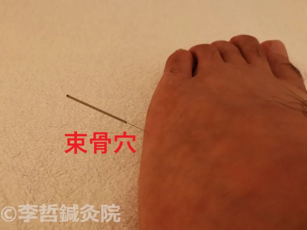 左足の束骨穴に鍼を刺した様子（上から撮影）。右腰痛を改善するために使用したツボです。