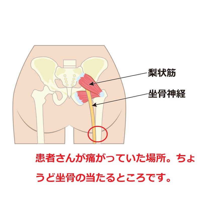 坐骨が痛くて歩けないおじいちゃん、鍼ですぐ治した