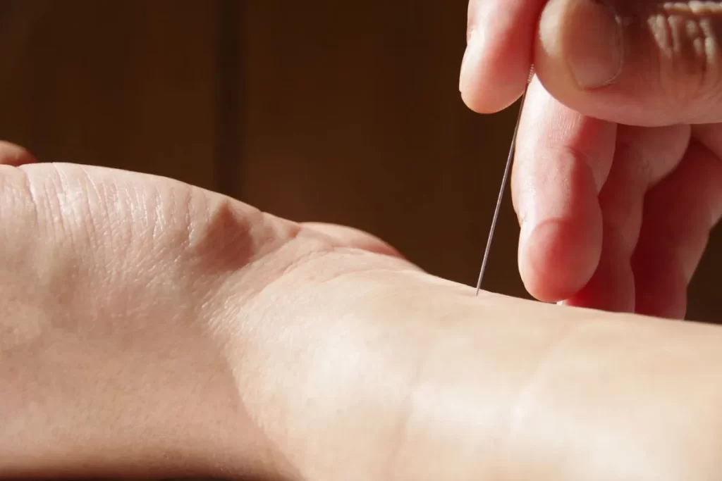 手の内関（ないかん）に鍼を刺す直前の写真