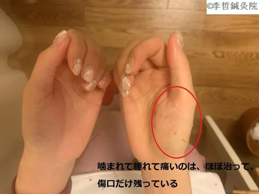 ミーアキャット咬傷1週間後 鍼灸で腫れが大幅に引いた右手親指