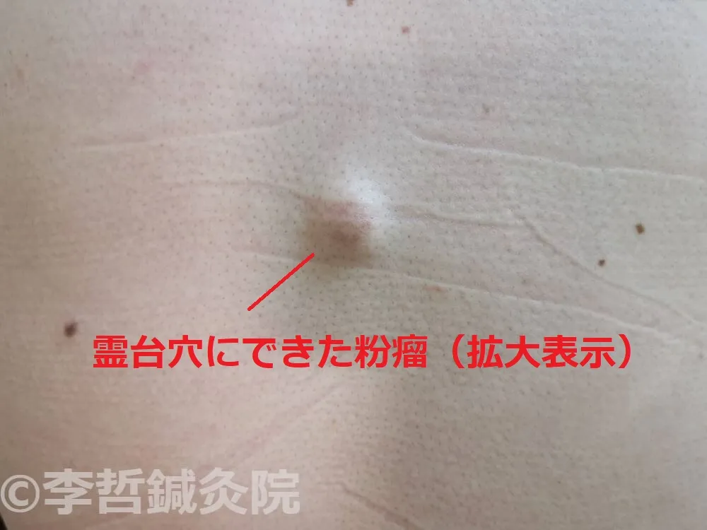 背中の脊柱にある霊台穴付近にできた粉瘤の拡大画像