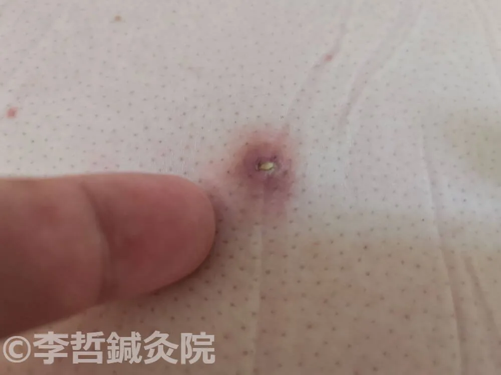 治療後に小さくなり平らになった背中の粉瘤の画像