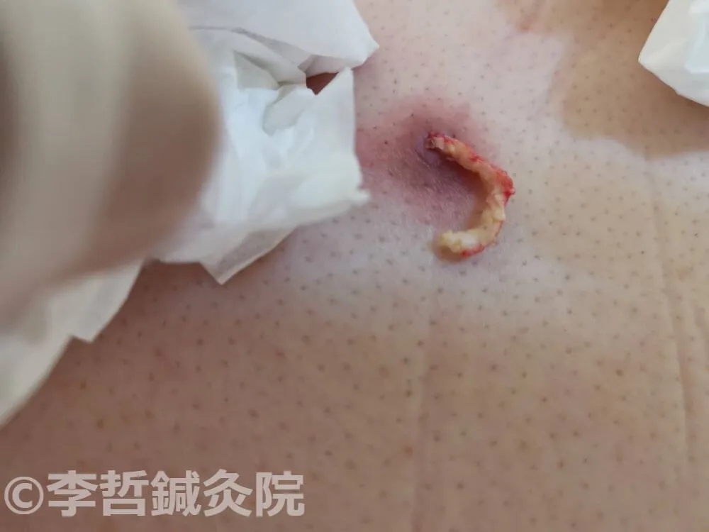 刺絡療法後に少量のゼリー状老廃物が排出された背中の画像