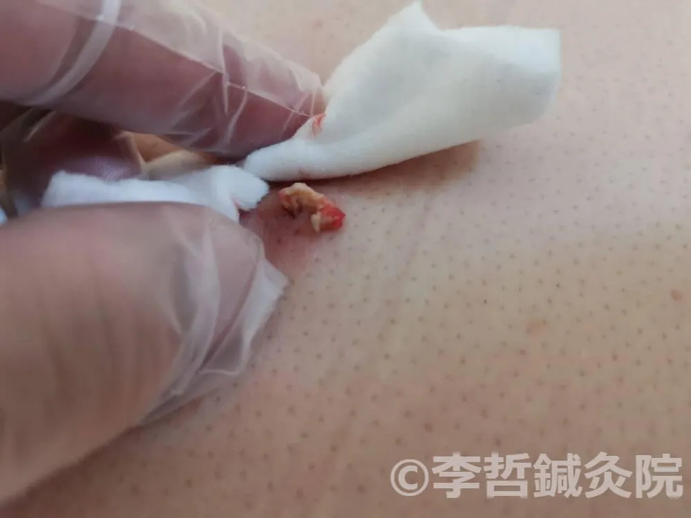 刺絡療法後に両手で絞り出し、血とゼリー状老廃物が排出された画像