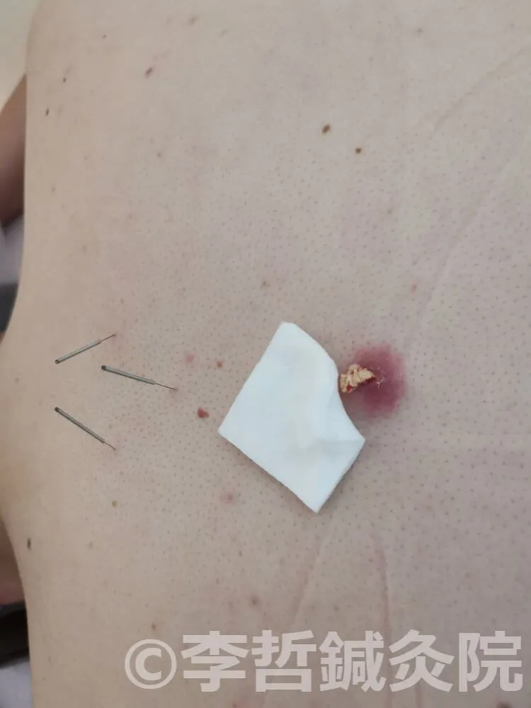 身柱穴に鍼を刺し、刺絡療法で黄色いゼリー状の老廃物を排出中の画像