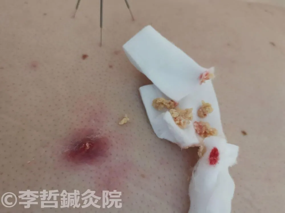 刺絡療法で排出されたゼリー状の老廃物が消毒綿に付着した画像