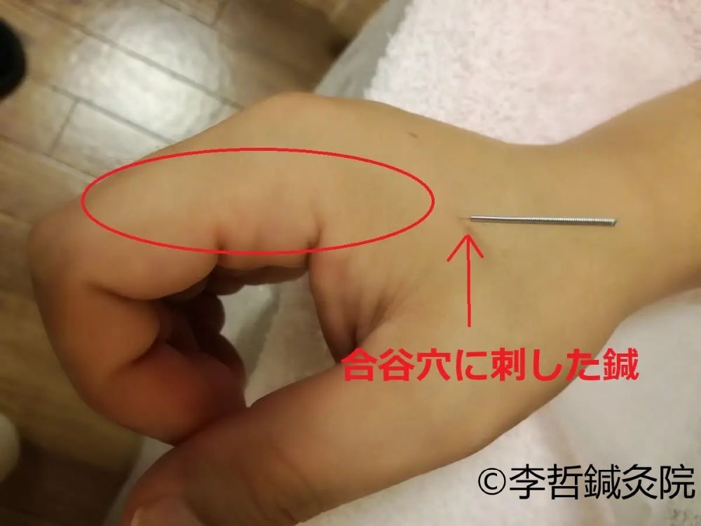 人差し指がしびれるのを一瞬で治した例