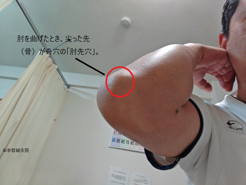 脇と唇のできもの、お灸だけで小さくなった例