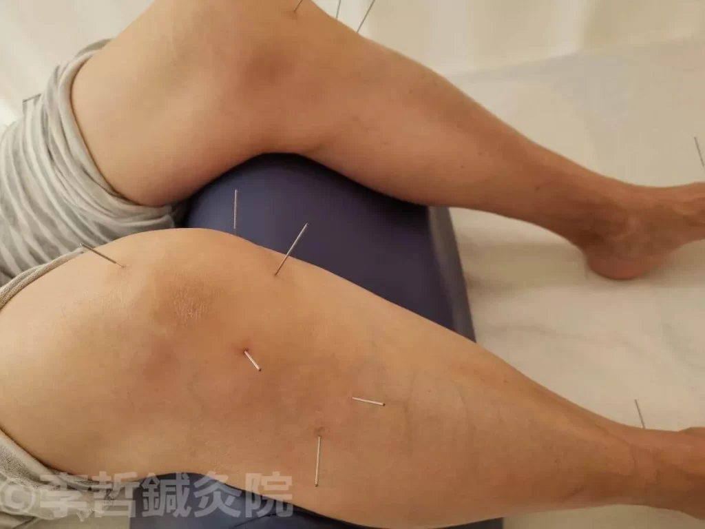 膝痛治療のための鍼灸施術：膝五鍼、足三里穴、犢鼻穴に鍼を刺す様子