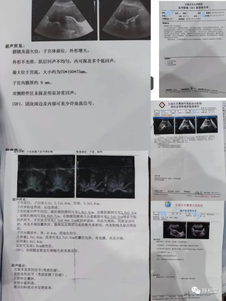 子宮筋腫の画像診断結果。10cmから2cmに縮小した漢方薬治療の経過を示す。