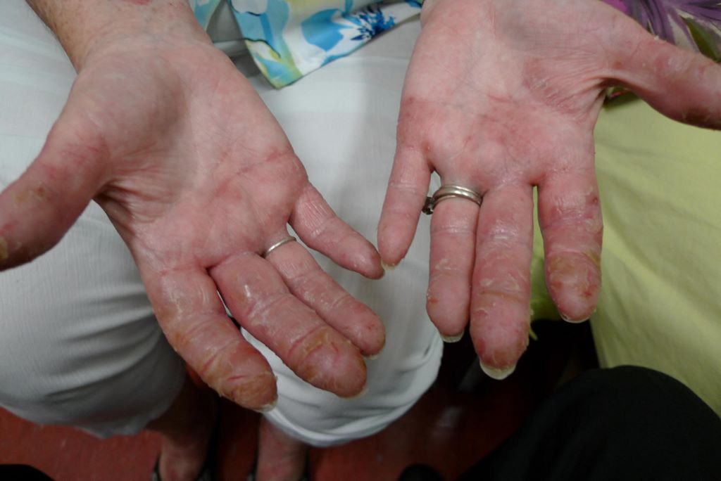 手足が氷みたいに冷たいと不妊症が治らない。乳腺症か乳がんか？中医学は質問するだけで分かる。皮膚が赤くて痛い、痒い患者、原因不明だと言われた