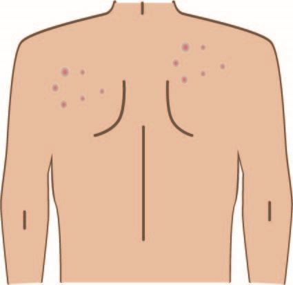 背中のニキビ、足の冷え、首こり肩こりは足つぼと刮痧（カッサー）で治り、体力も増えた例。