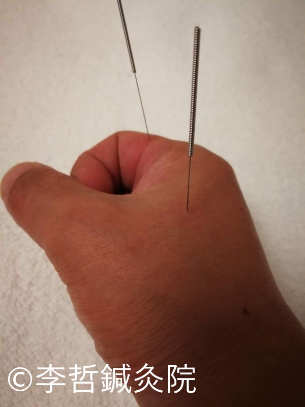 右手に刺した針：二間と合谷。