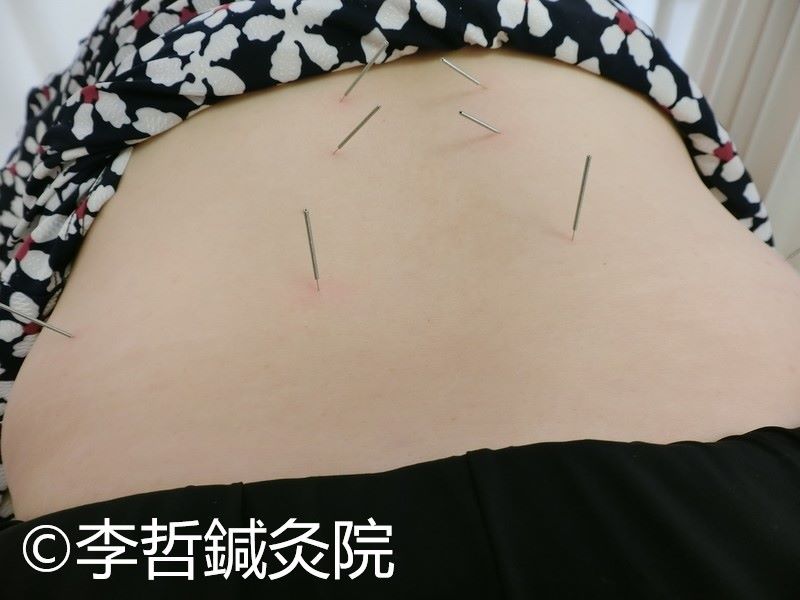 左腰の痛みとゲップが出るのはだいぶ減って、鍼しているうちにお腹が空いてきた。