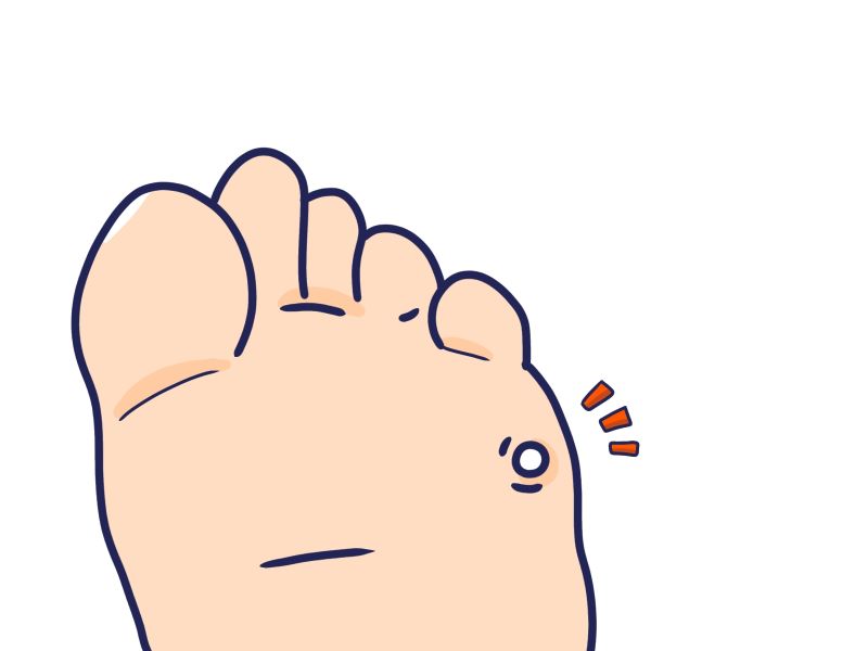 足の小指の裏側にできた痛みを伴う魚の目を表現したイラスト
