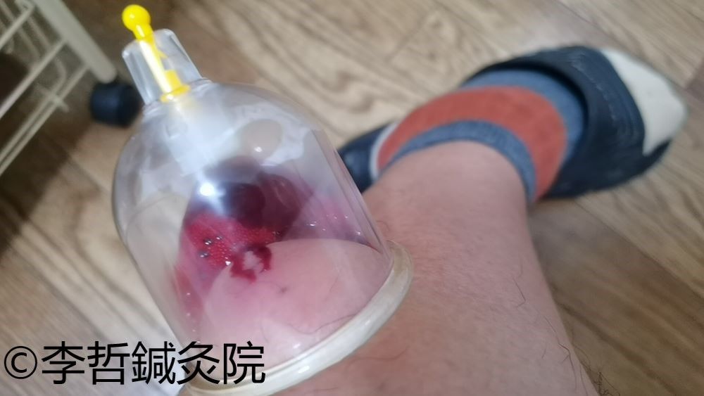 足すねの赤くて痛い発疹、刺絡療法だけで治した例