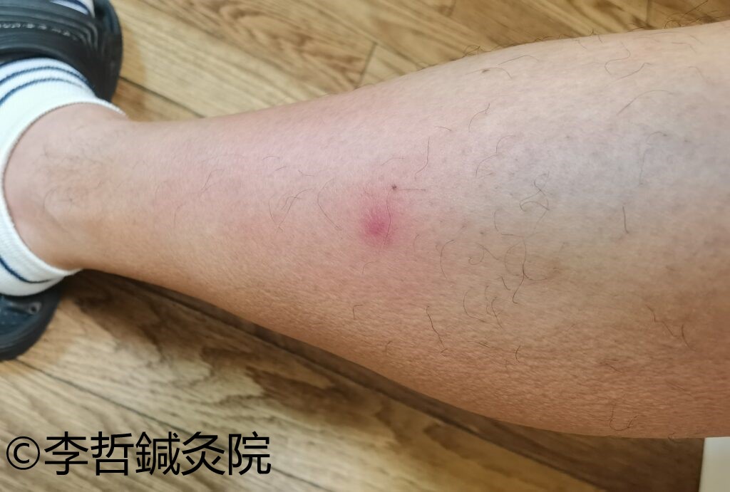 左足の外側に赤くて痛い発疹ができた