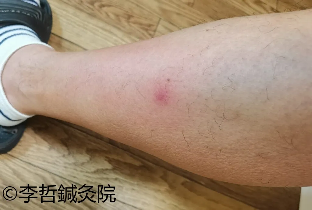 左すね外側にできた赤く腫れた痛い発疹の様子（2024年6月14日撮影）