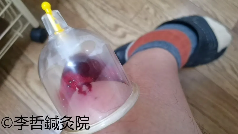 刺絡療法でカッピングを付け、瘀血を抜いている様子