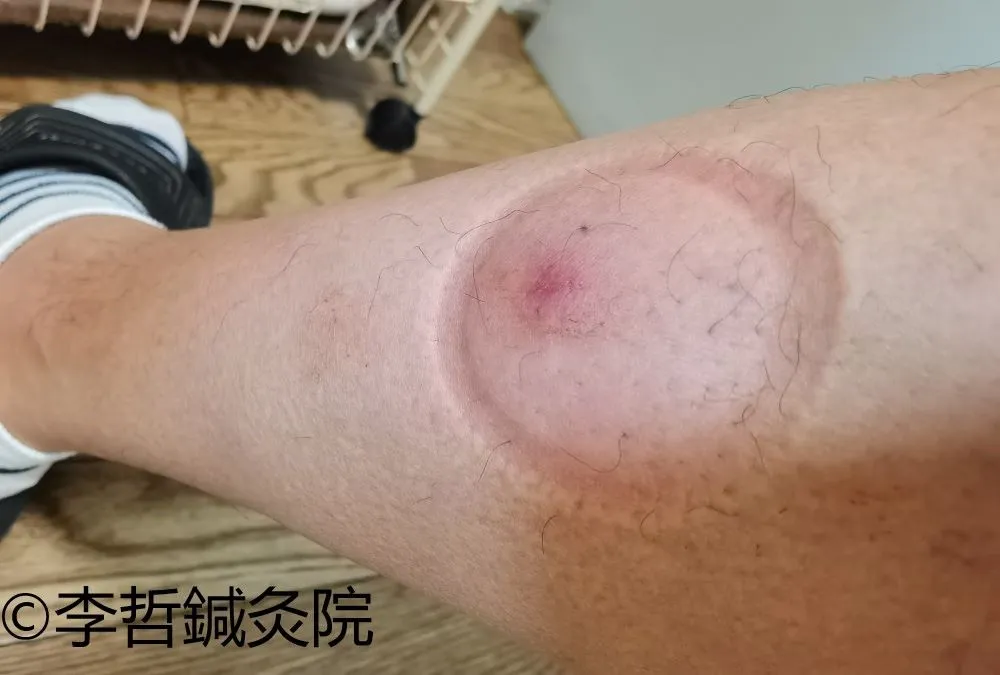 刺絡療法後の左足スネ。カッピングの丸い跡が残っている状態