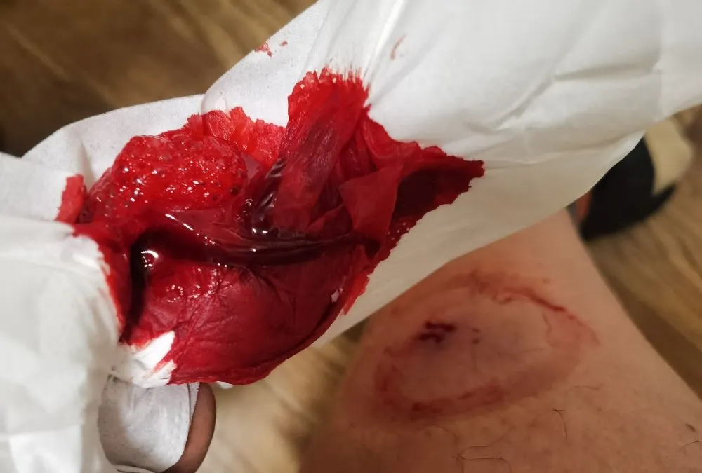 刺絡療法で出たネバネバする黒い瘀血と鮮血（ティッシュに付いた様子）