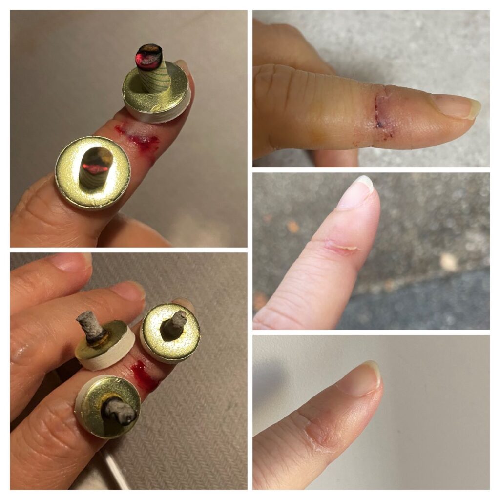 指が包丁に切られて出血したのはお灸ですぐ治った