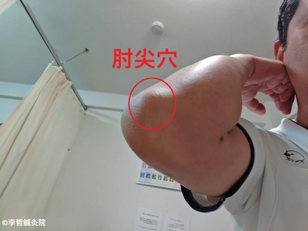 脇の下のコリコリしたしこり（デキモノ）改善におすすめの奇穴「肘尖穴（ちゅうせんけつ）」の位置。肘の尖った骨の先端に赤丸と赤文字で表示。