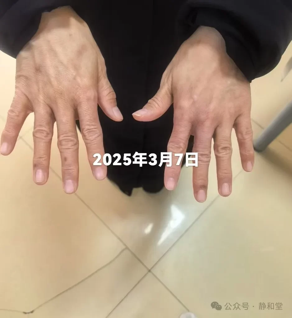 湿疹治療後の手の状態(2025年3月7日) 48歳女性の湿疹治療後の手(2025年3月7日)。赤みやひび割れが完全に消失し、滑らかで健康的な皮膚。指に軽いしわが残るが、非常に綺麗な状態。