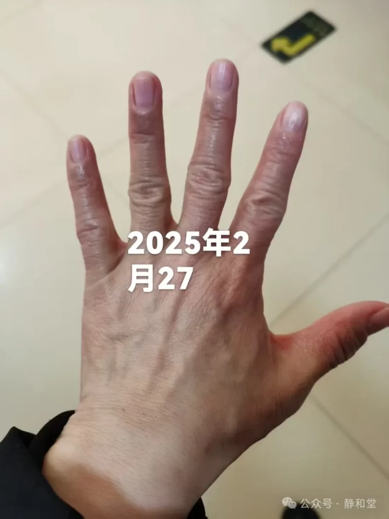 湿疹治療後期の手の状態(2025年2月27日) 48歳女性の湿疹治療後期の手(2025年2月27日)。赤みはほぼ消失し、指のひび割れが最小限に。軽いしわと乾燥が残る。