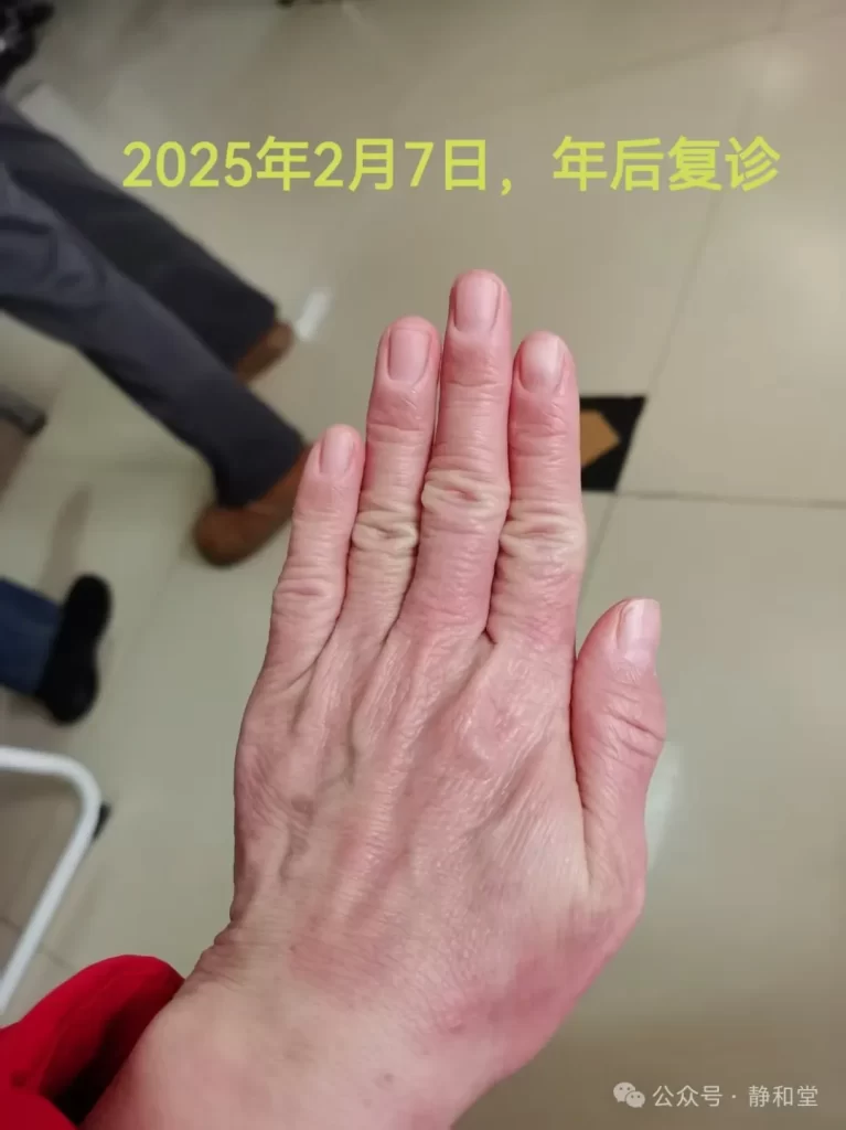 湿疹治療中の手の状態(2025年2月7日) 48歳女性の湿疹治療中の手(2025年2月7日)。赤みと腫れが軽減し、ひび割れも減少したが、指の乾燥と軽いかさつきが残る。