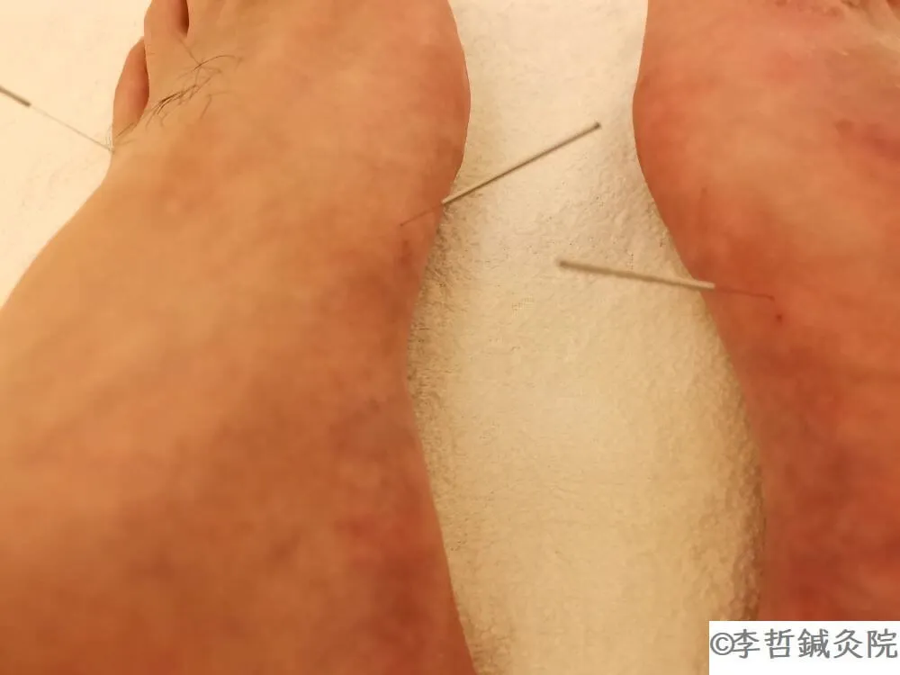 口角炎治療で公孫穴(こうそんけつ)に鍼を刺した足の内側の写真