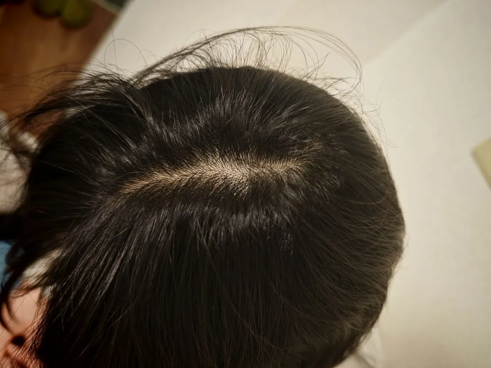 円形脱毛症完治・全体像（2025年5月