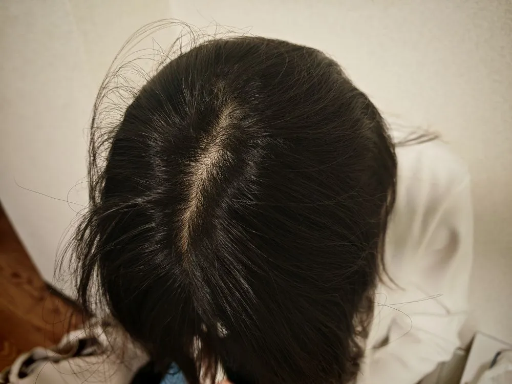 円形脱毛症完治・治療後（同じ角度で比較）