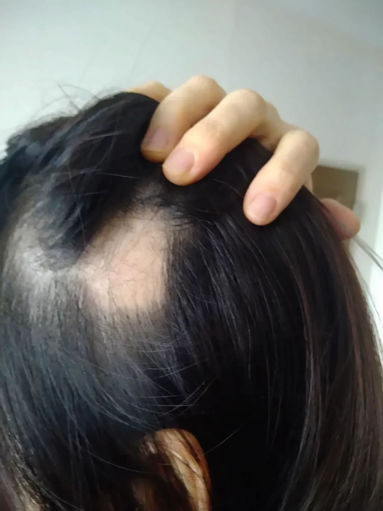 円形脱毛症治療前（2024年2月）直径5cmの重症例