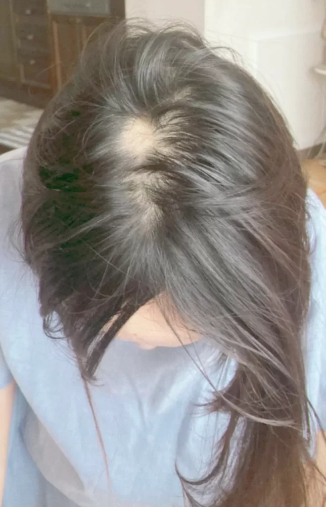 円形脱毛症治療3ヶ月後・頭頂部（同じ角度で比較）