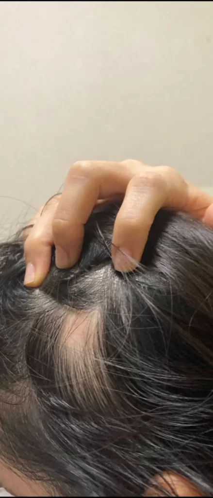 円形脱毛症治療3ヶ月後・側頭部