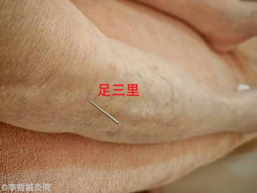 足三里に鍼を刺した実際の施術写真。赤文字で足三里と表記。背中の真ん中の痛み治療に使用。
