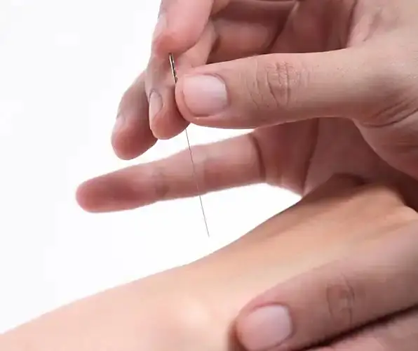 鍼灸師の手が患者の手のツボに鍼を刺入しようとするクローズアップ