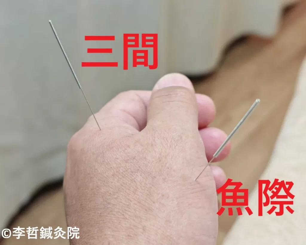 左手的三間（さんかん）と魚際（ぎょさい）に鍼を刺した写真。水っぽい鼻水とくしゃみが止まらない症状を2日で完治