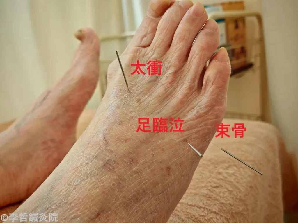 足臨泣、束骨、太衝に鍼を刺した実際の施術画像。赤文字で各ツボ名を表記。急な背中の痛み（真ん中）を治療。